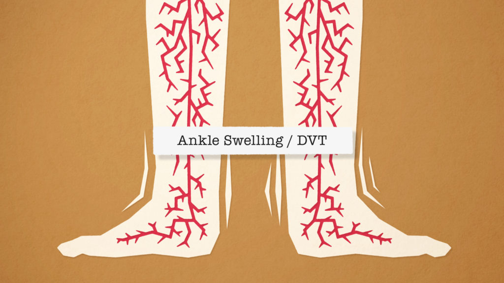 Clots are caused by the twin pressures of low cabin pressure and lack of movement, so be sure to follow our hypoxia advice above